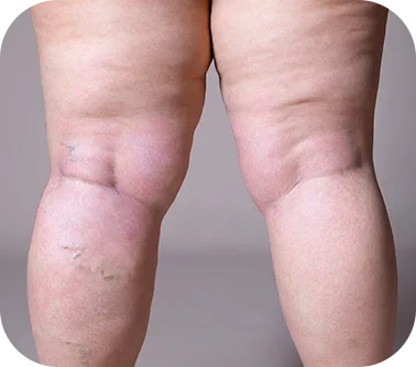 Lymphedema